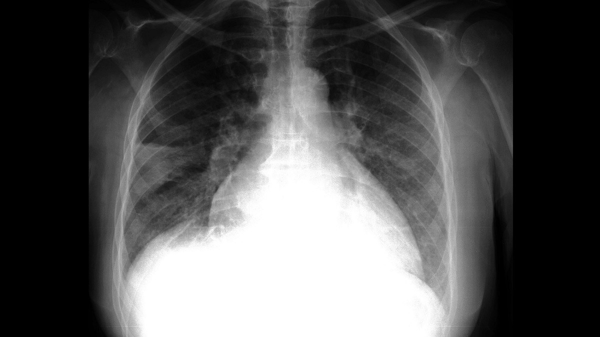 x-ray of lungs